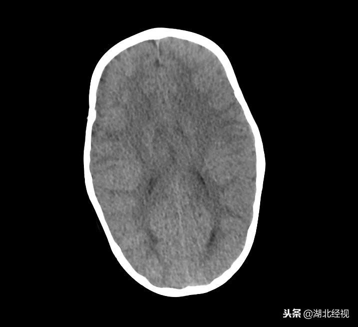 三个月宝宝头扁怎么办？全面解析与应对策略